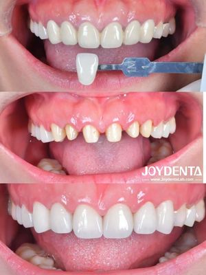 Circonia Dental Crown Case Study -- Global Lab Outsourcing -- Joydentalab