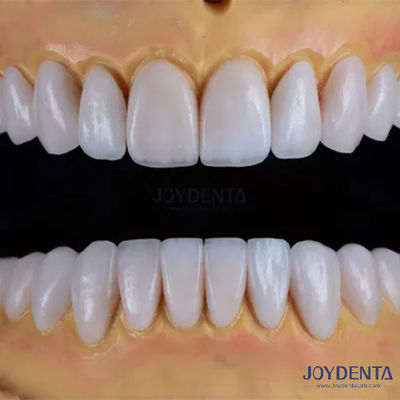 Finestre di porcellana Emax realizzate su misura Restorazioni dentali di consistenza liscia