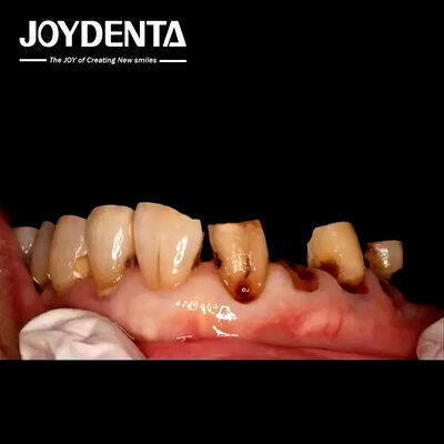 Corone di zirconia di prima qualità per i laboratori dentali globali.