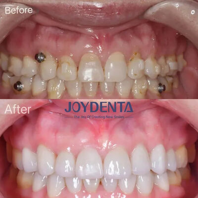 Finestre dentali per denti mancanti.