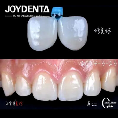 Indicazione dei denti anteriori Finiture dentali senza necessità di preparazione e senza decolorazione