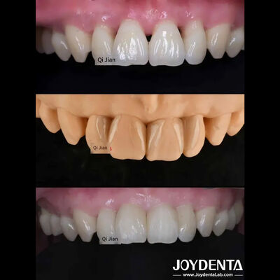 I rivestimenti per denti di scimmia: la soluzione perfetta per i rivestimenti dentali di trasparenza naturale