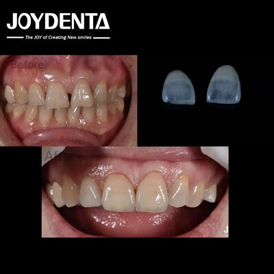 0Spessore di.5 mm Finiture dentali in ceramica Naturale in cerca di denti anteriori Indicazione