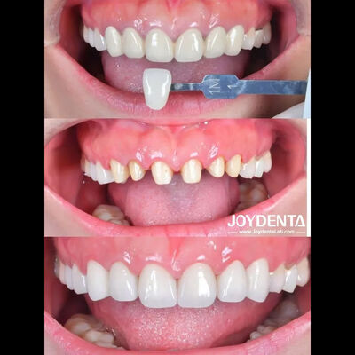 Circonia Dental Crown Case Study -- Global Lab Outsourcing -- Joydentalab