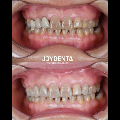 Circonia dentale leggera per un'esperienza ottimale del paziente