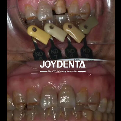 Corone in Zirconia Traslucente Tecnologia Multistrato Gradiente