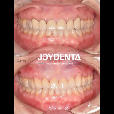 Zirconia Dentale Per Tessuti Orali Sicuri E Compatibilità CAD/CAM