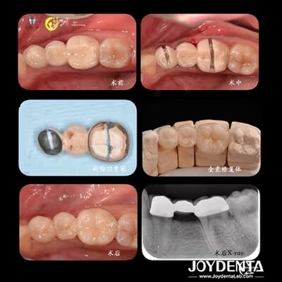 Corona dentale in zirconio personalizzata Biocompatibilità Comfort Personalizzazione
