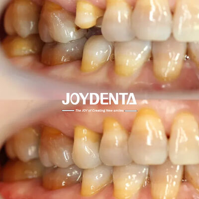 Personalizzabile Prezzi accessibili Dental Inlay Restorative Precise Fit per denti danneggiati