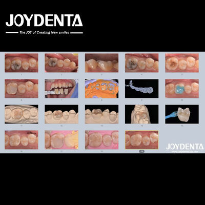 Adulti Bambini Infissi dentali in ceramica di porcellana per denti danneggiati