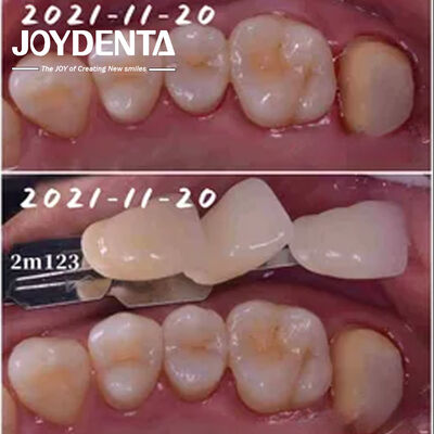 Procedura dentale in legno di porcellana senza cuciture Forma personalizzabile per la riparazione dei denti