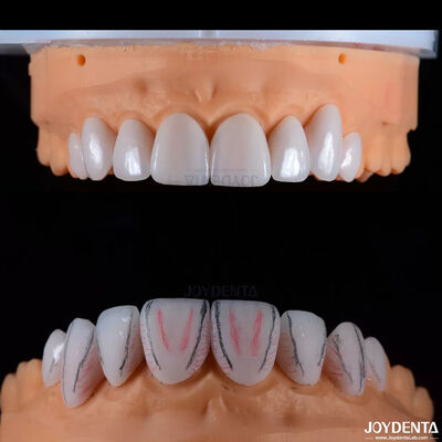 Finiture in ceramica Emax dentistiche su misura con alto lucentezza resistente alle macchie