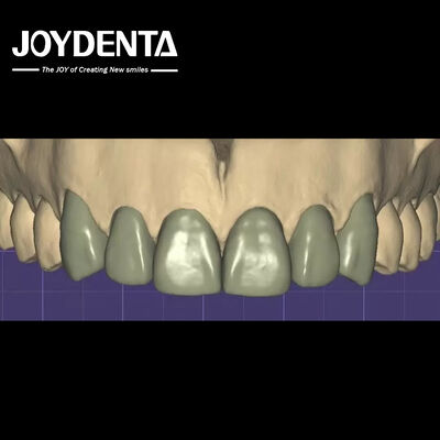 Stampa 3D Virtual Digital Wax Up Compatibilità senza soluzione di continuità con altri software dentali